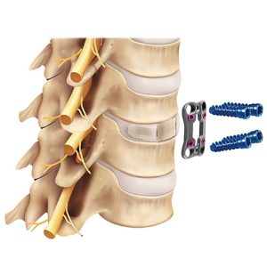 Cervical Plate and Screws — HCM Orthocare Spinal Implant Manufacturer
